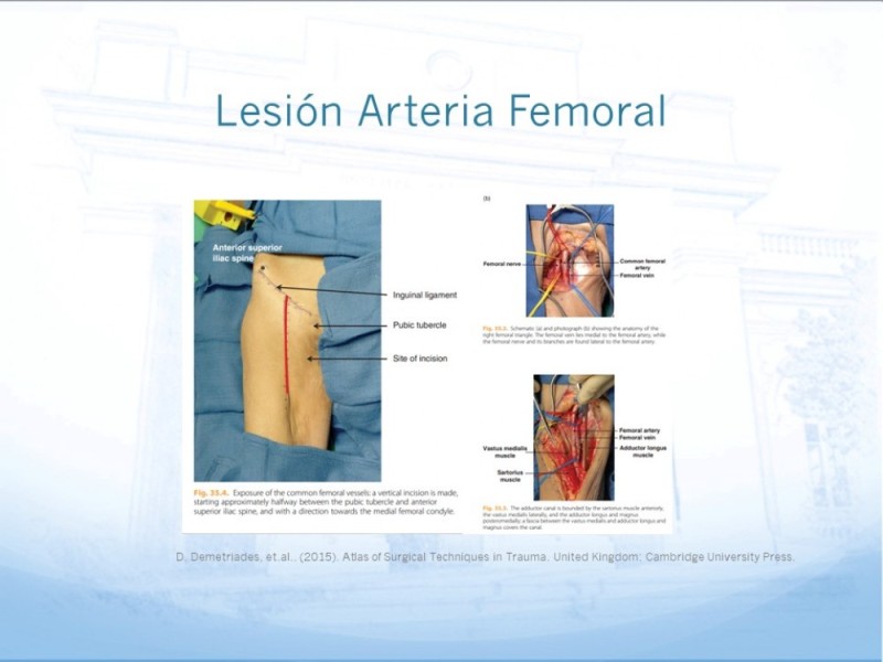 Diapositiva 22 de Control de lesión vascular para el cirujano general