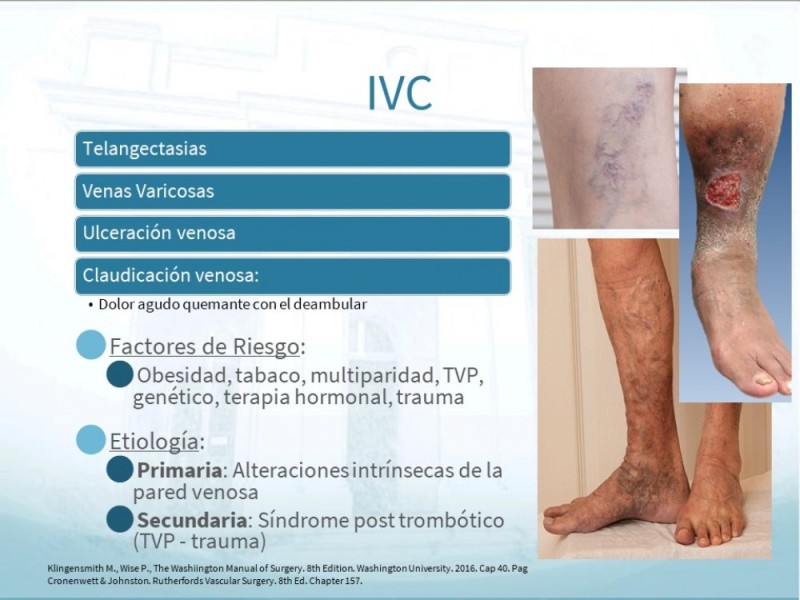 Diapositiva 4 de Insuficiencia Venosa Crónica