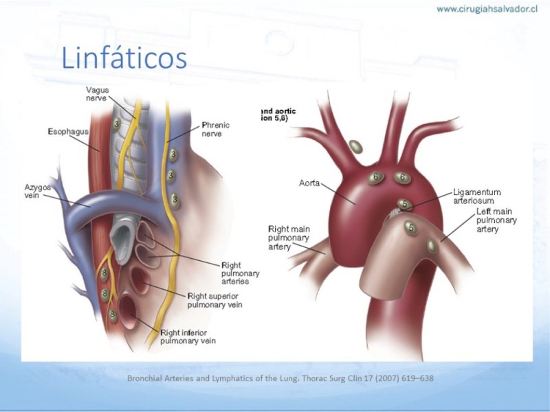 Diapositiva 20 de Anatomía Quirúrgica: Pulmón y Bronquios