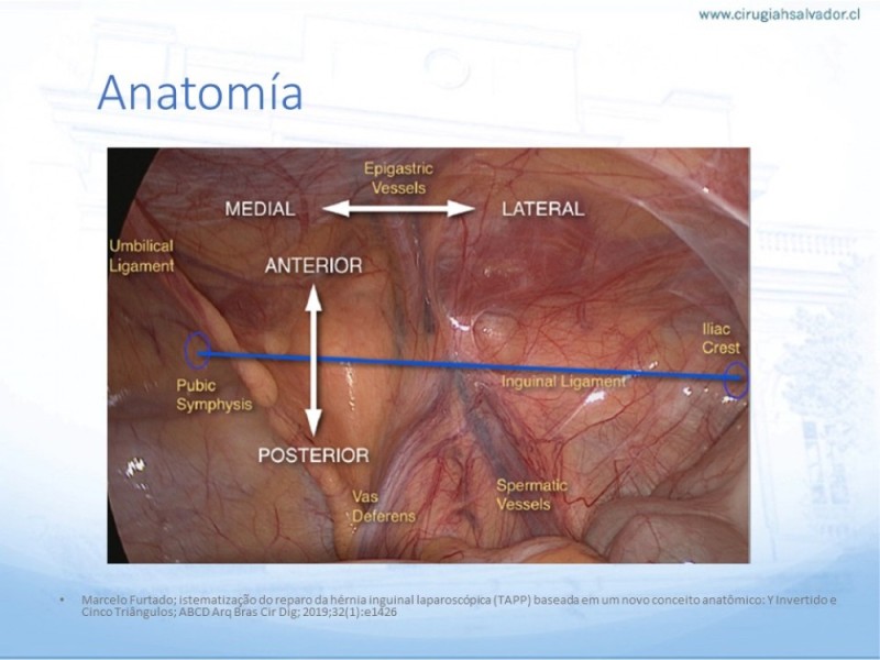 Diapositiva 12 de Hernia Inguinal: Hitos Anatómicos para cirugía laparoscópica-3