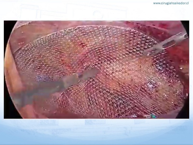 Diapositiva 23 de Hernia Inguinal: Hitos Anatómicos para cirugía laparoscópica-3