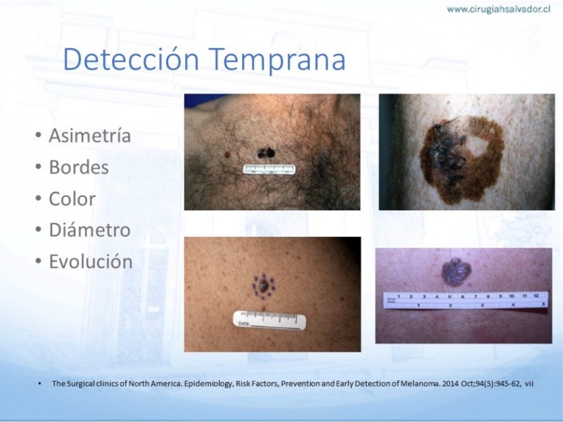 Diapositiva 5 de Manejo Quirúrgico del Melanoma