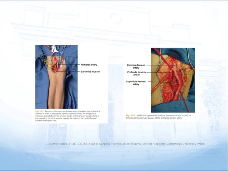 Diapositiva 23 de Control de lesión vascular para el cirujano general