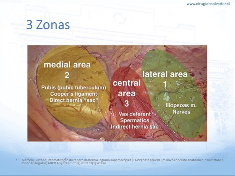 Diapositiva 16 de Hernia Inguinal: Hitos Anatómicos para cirugía laparoscópica-3