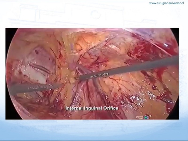 Diapositiva 22 de Hernia Inguinal: Hitos Anatómicos para cirugía laparoscópica-3