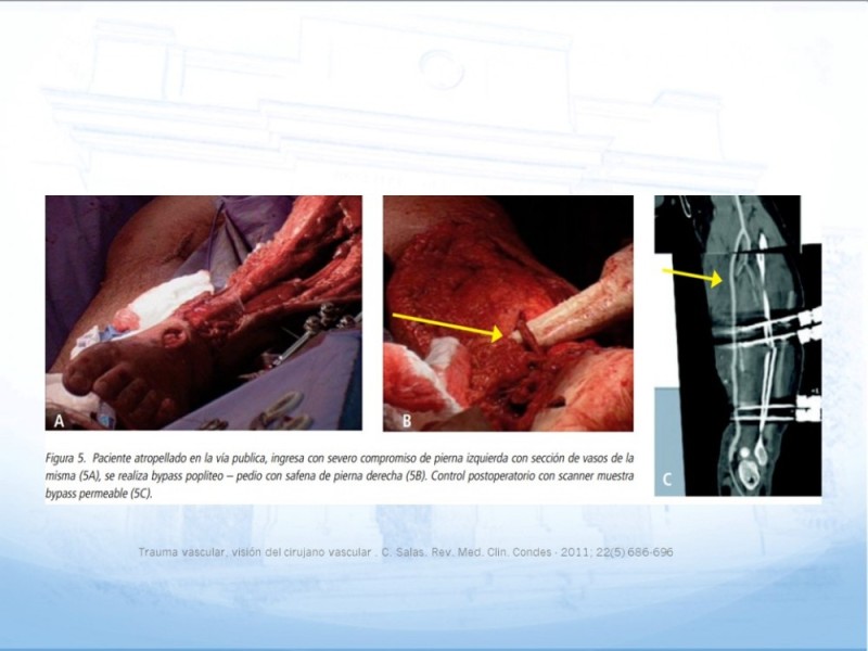 Diapositiva 13 de Control de lesión vascular para el cirujano general