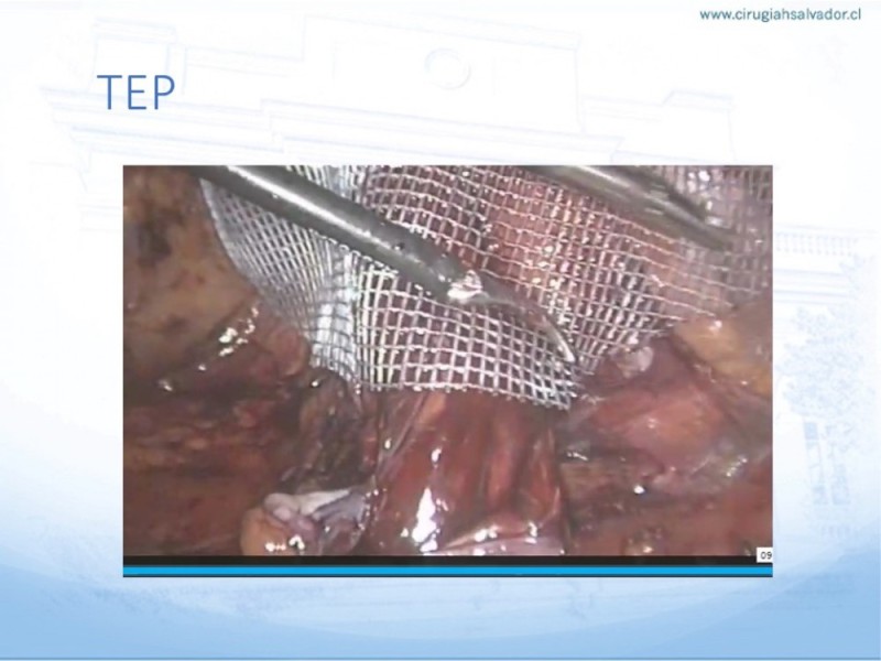 Diapositiva 33 de Hernia Inguinal: Hitos Anatómicos para cirugía laparoscópica-3