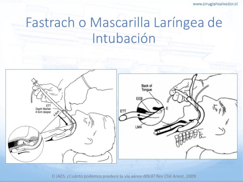 Diapositiva 28 de Manejo de Vía Aérea. Evaluación, Dispositivos y Algoritmos DAS