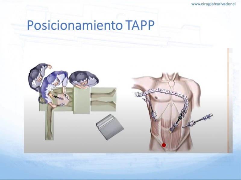 Diapositiva 18 de Hernia Inguinal: Hitos Anatómicos para cirugía laparoscópica-3