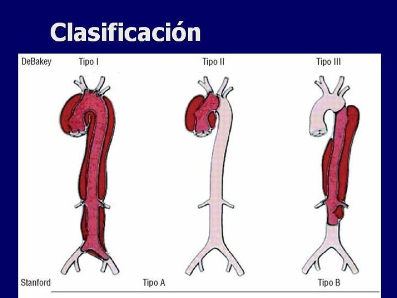 Diapositiva 6 de Disección Aórtica
