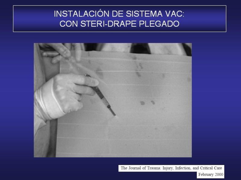 Diapositiva 41 de El Sistema VAC en la laparotomía contenida
