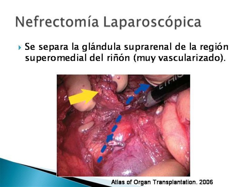 Diapositiva 74 de Técnica de procuramiento renal