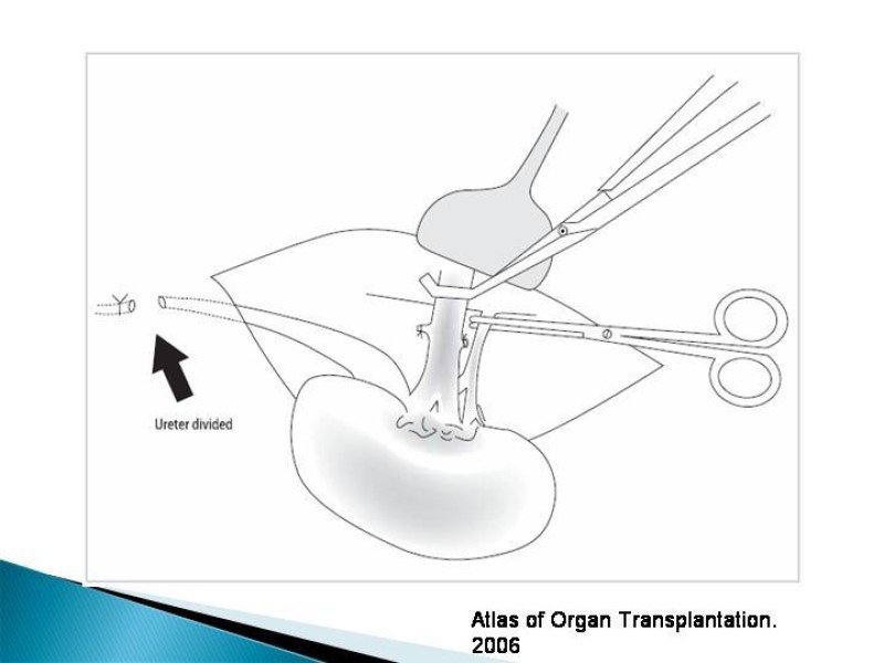 Diapositiva 50 de Técnica de procuramiento renal