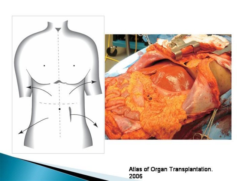 Diapositiva 26 de Técnica de procuramiento renal