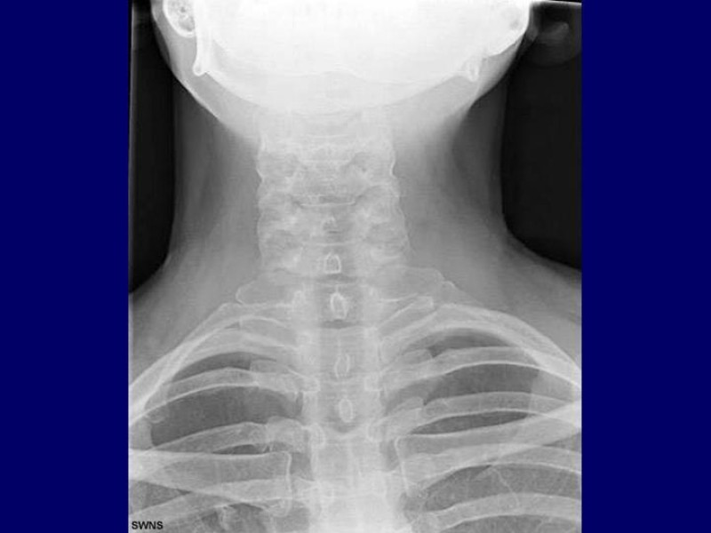 Diapositiva 11 de Síndrome del Opérculo Torácico