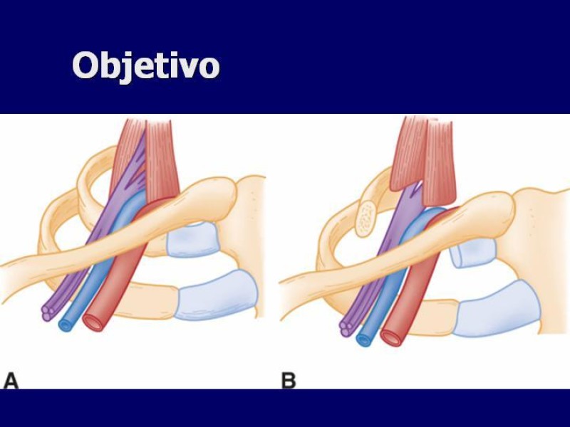 Diapositiva 22 de Síndrome del Opérculo Torácico
