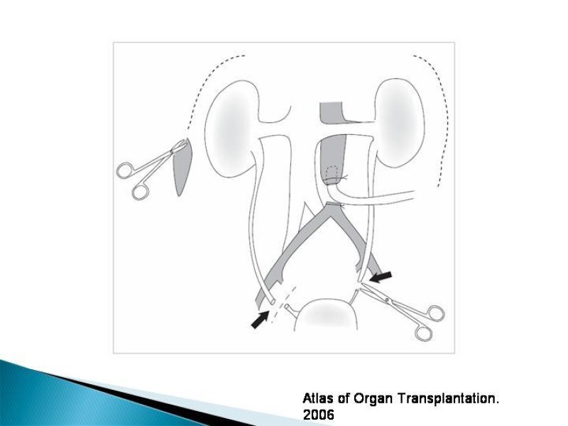 Diapositiva 31 de Técnica de procuramiento renal
