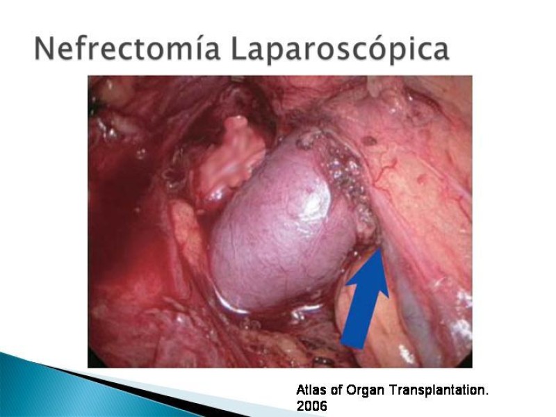 Diapositiva 68 de Técnica de procuramiento renal