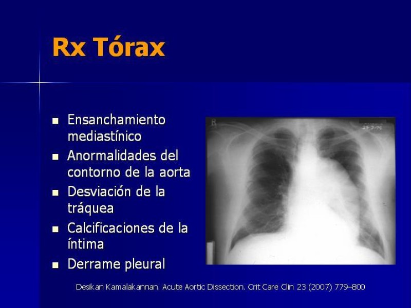 Diapositiva 16 de Disección Aórtica