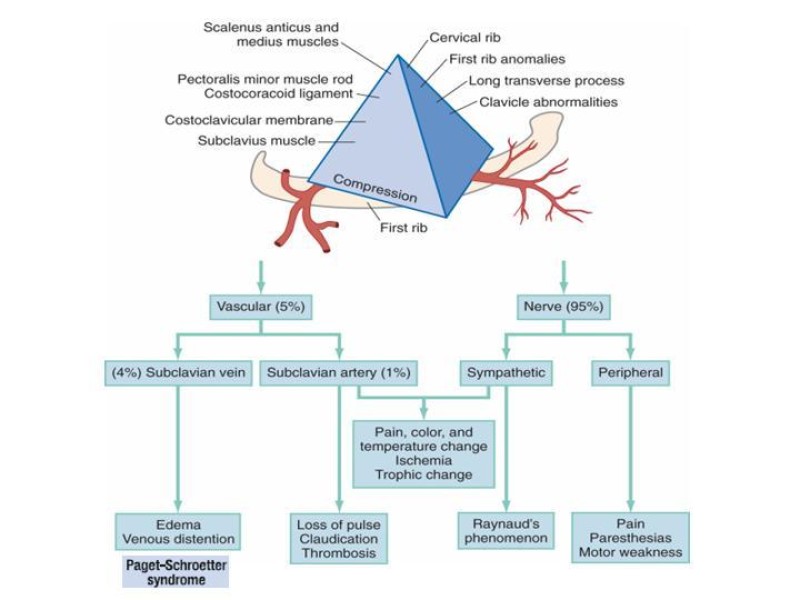 Diapositiva 6 de Síndrome del Opérculo Torácico