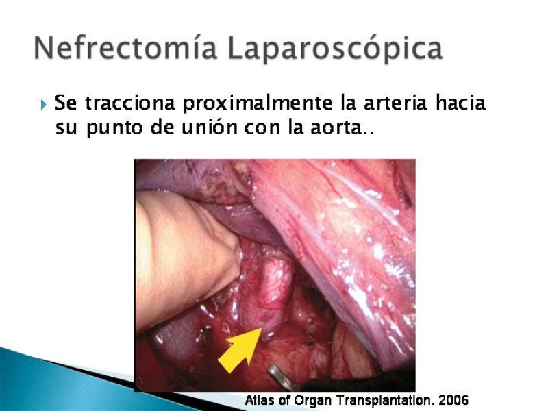 Diapositiva 72 de Técnica de procuramiento renal