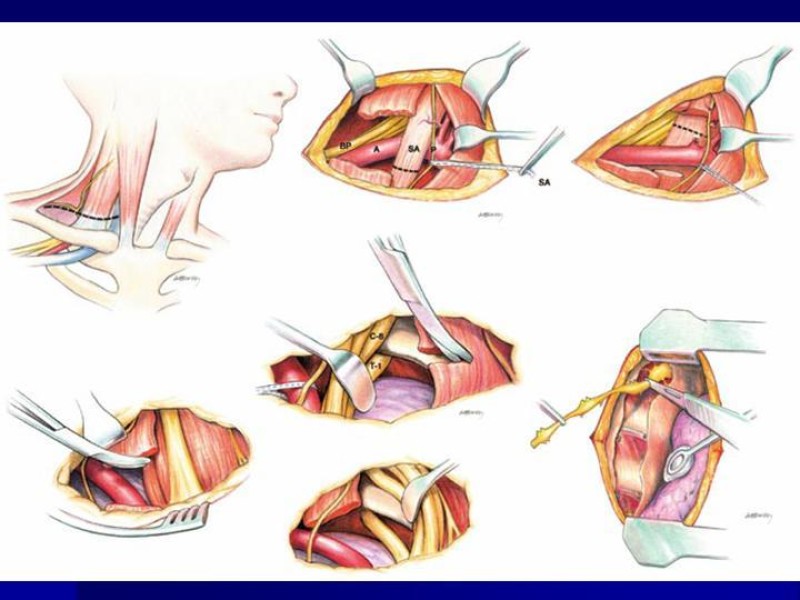 Diapositiva 24 de Síndrome del Opérculo Torácico