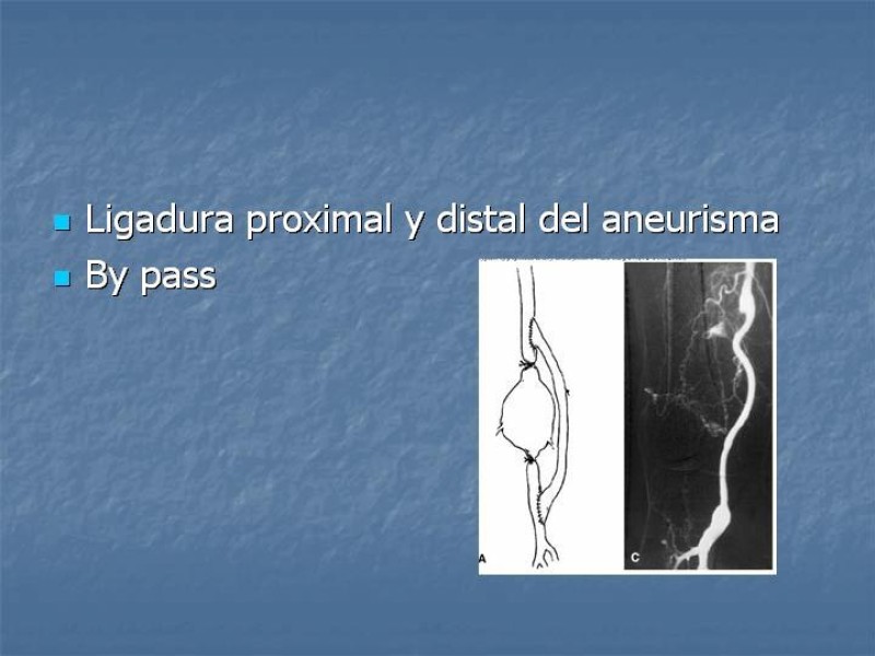 Diapositiva 16 de Aneurisma arterial poplíteo