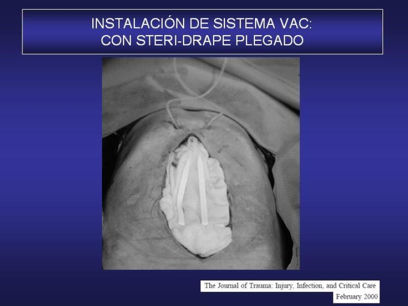 Diapositiva 44 de El Sistema VAC en la laparotomía contenida