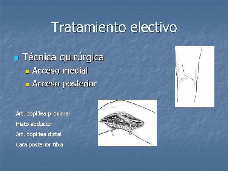 Diapositiva 14 de Aneurisma arterial poplíteo