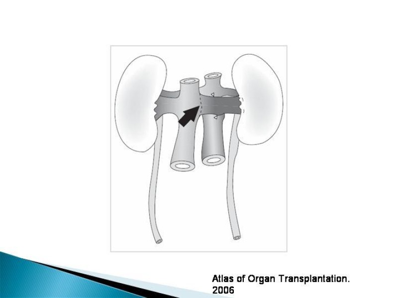 Diapositiva 34 de Técnica de procuramiento renal