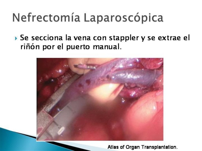 Diapositiva 80 de Técnica de procuramiento renal