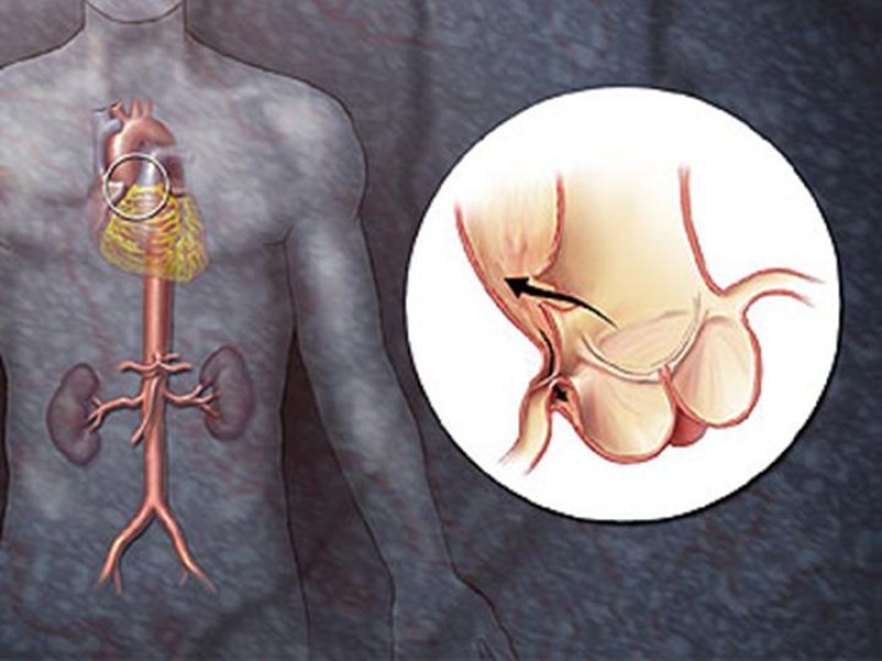 Diapositiva 7 de Disección Aórtica