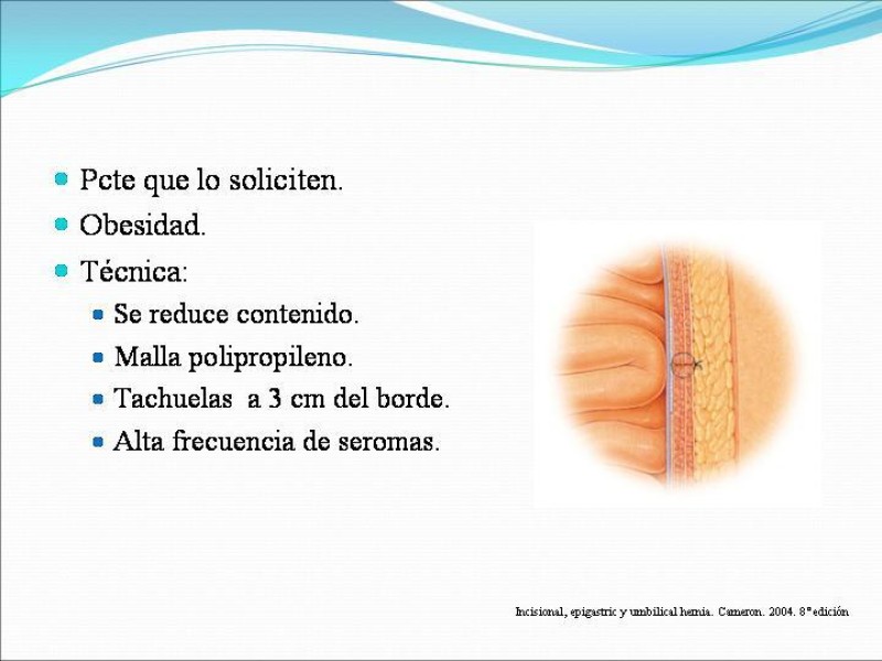 Diapositiva 6 de Hernia Umbilical, Epigástrica y Spieguel