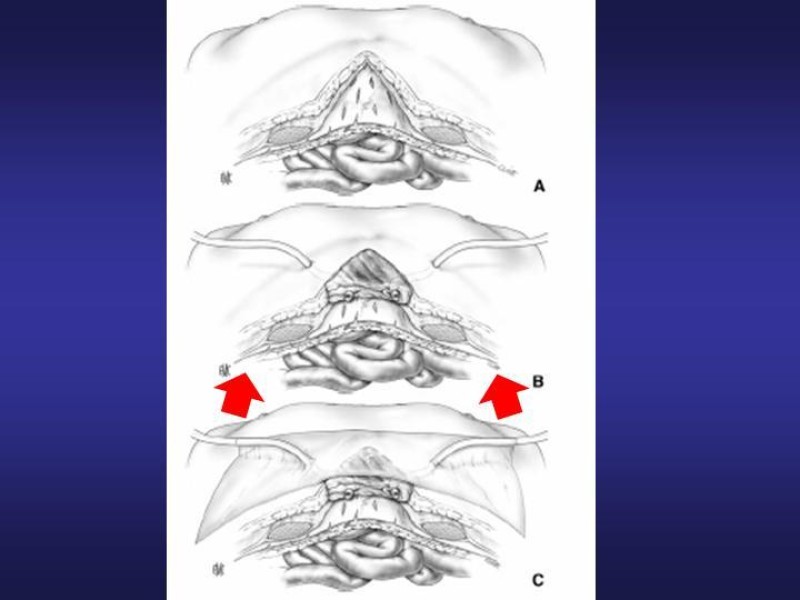 Diapositiva 47 de El Sistema VAC en la laparotomía contenida