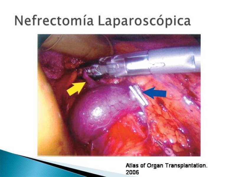 Diapositiva 70 de Técnica de procuramiento renal