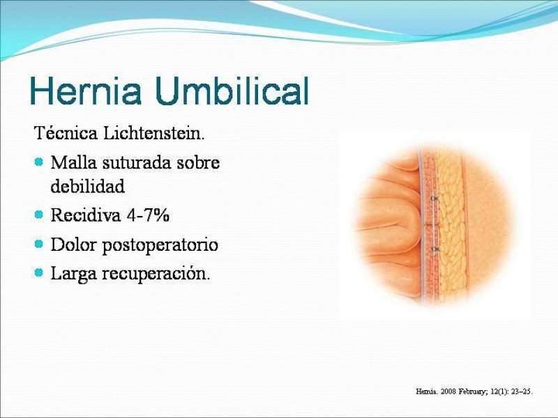 Diapositiva 10 de Hernia Umbilical, Epigástrica y Spieguel