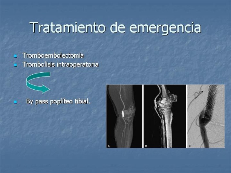 Diapositiva 18 de Aneurisma arterial poplíteo