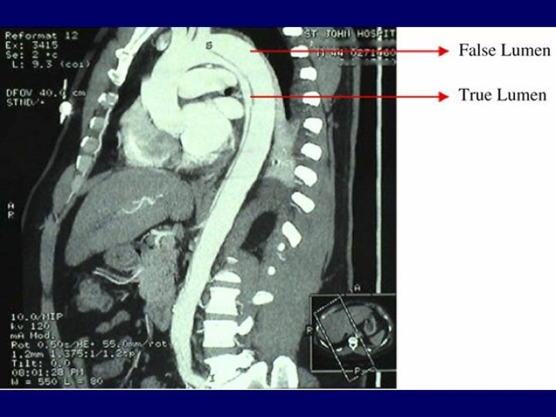 Diapositiva 21 de Disección Aórtica