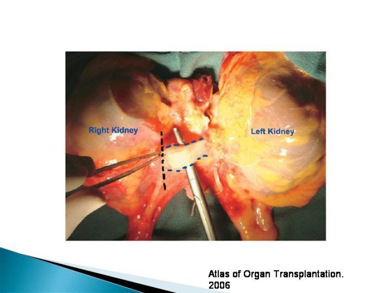Diapositiva 35 de Técnica de procuramiento renal