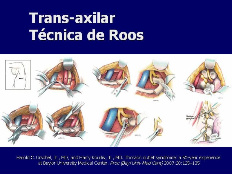 Diapositiva 23 de Síndrome del Opérculo Torácico