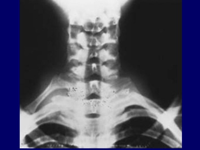 Diapositiva 12 de Síndrome del Opérculo Torácico