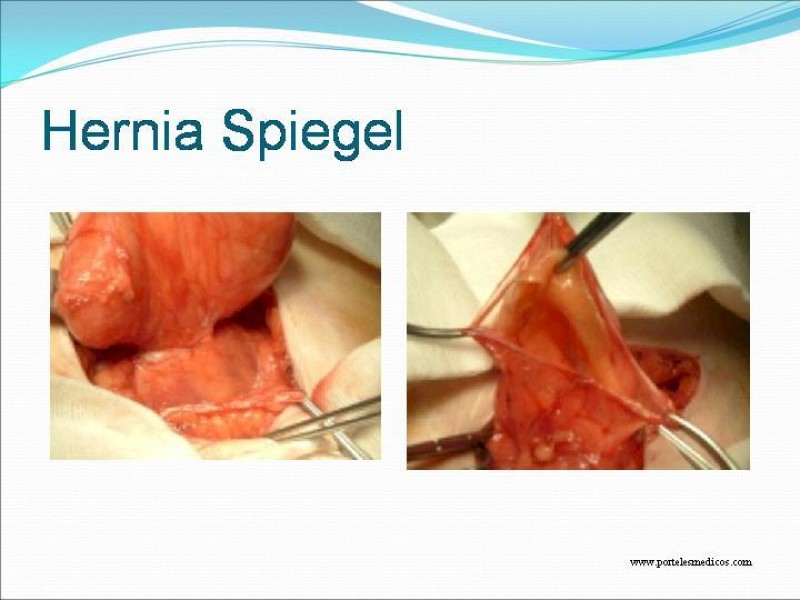 Diapositiva 23 de Hernia Umbilical, Epigástrica y Spieguel