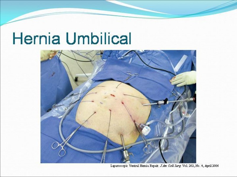 Diapositiva 9 de Hernia Umbilical, Epigástrica y Spieguel
