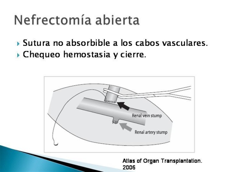 Diapositiva 51 de Técnica de procuramiento renal