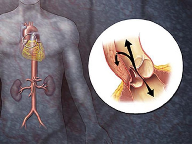 Diapositiva 8 de Disección Aórtica