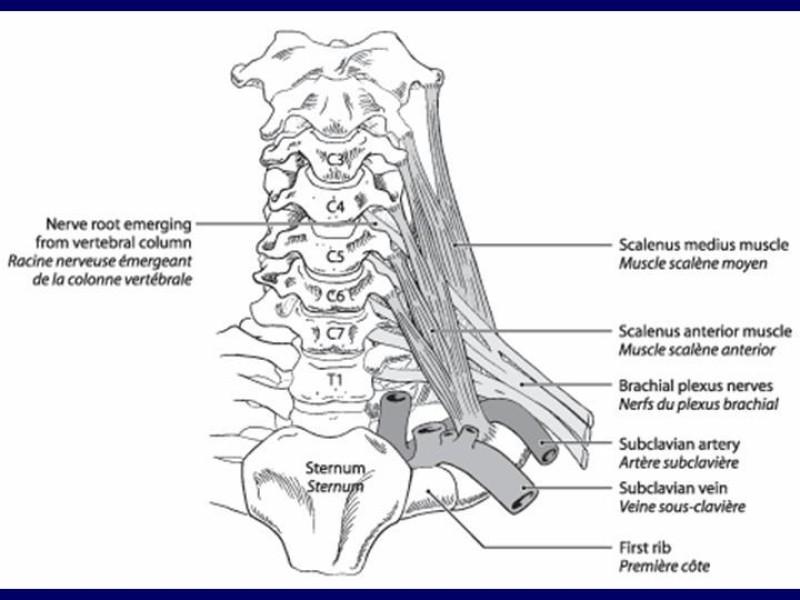 Diapositiva 4 de Síndrome del Opérculo Torácico
