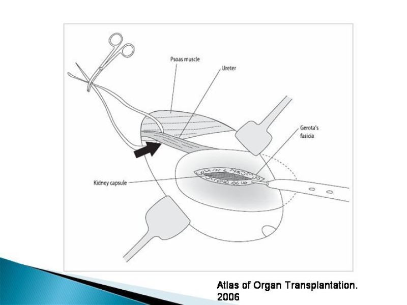 Diapositiva 45 de Técnica de procuramiento renal