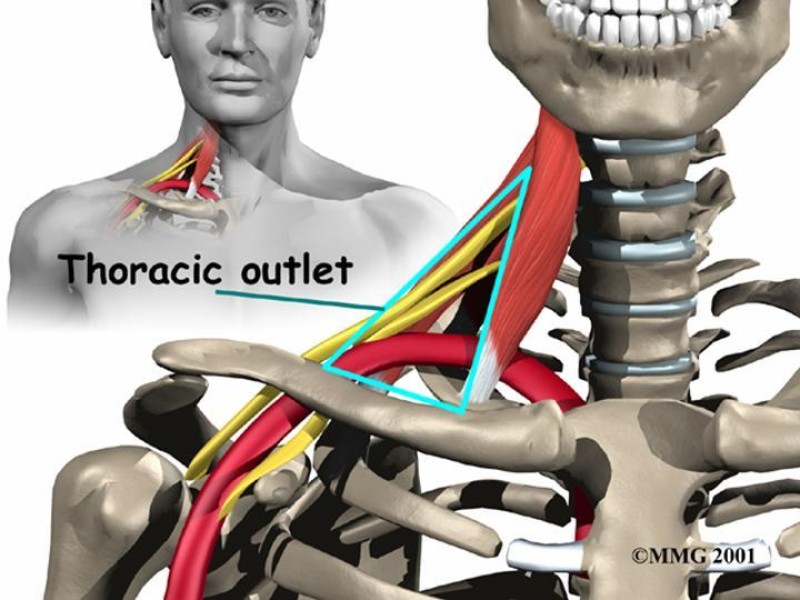 Diapositiva 3 de Síndrome del Opérculo Torácico