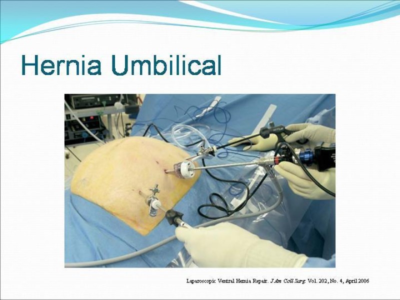 Diapositiva 7 de Hernia Umbilical, Epigástrica y Spieguel