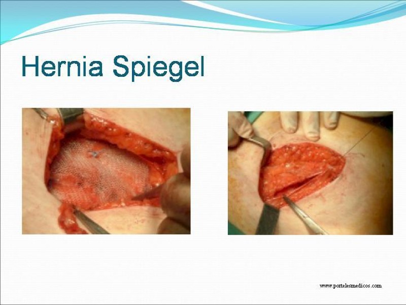 Diapositiva 25 de Hernia Umbilical, Epigástrica y Spieguel